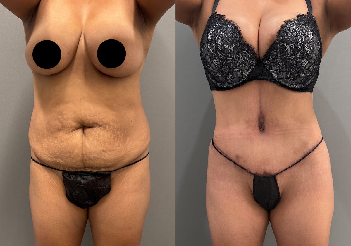 Tummy Tuck Before & After Gallery - Patient 351197 - Image 1