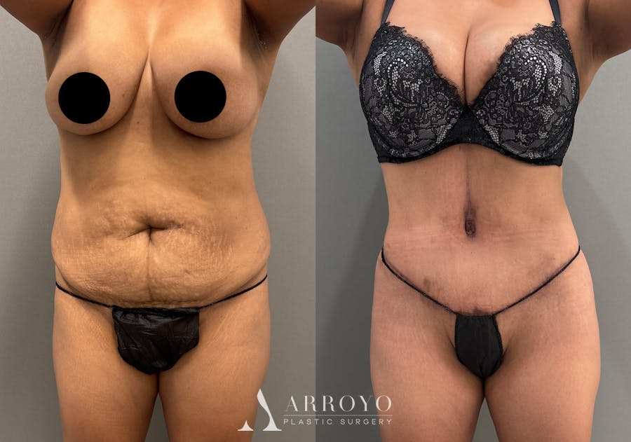 Tummy Tuck Before & After Gallery - Patient 351197 - Image 1