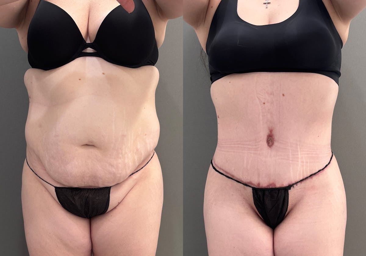 Liposuction Before & After Gallery - Patient 197100 - Image 1