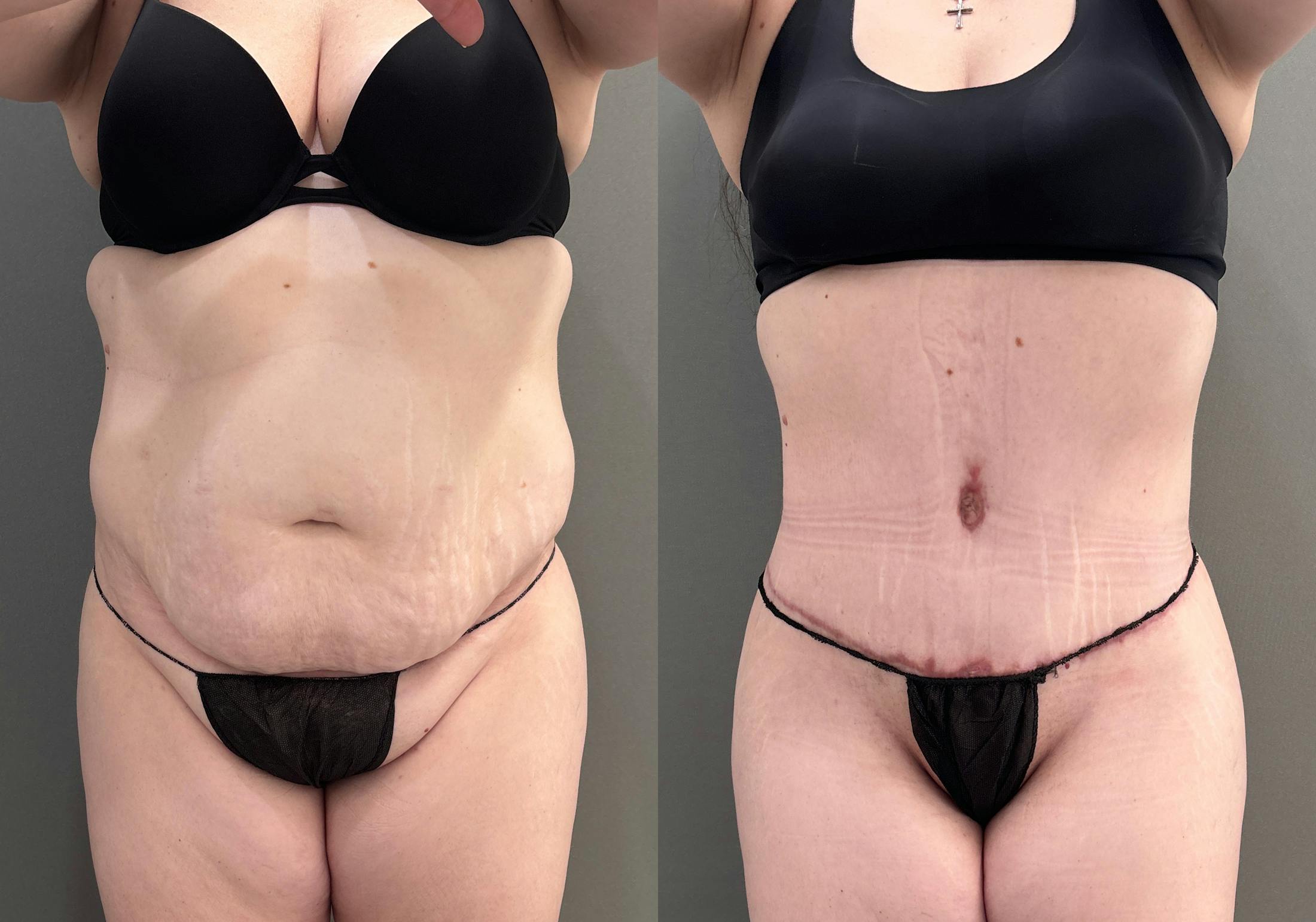 Tummy Tuck Before & After Gallery - Patient 340366 - Image 1