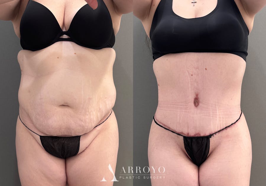Tummy Tuck Before & After Gallery - Patient 340366 - Image 1