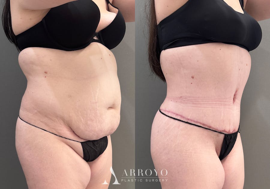 Tummy Tuck Before & After Gallery - Patient 340366 - Image 2