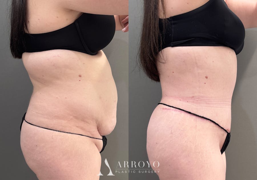 Tummy Tuck Before & After Gallery - Patient 340366 - Image 3