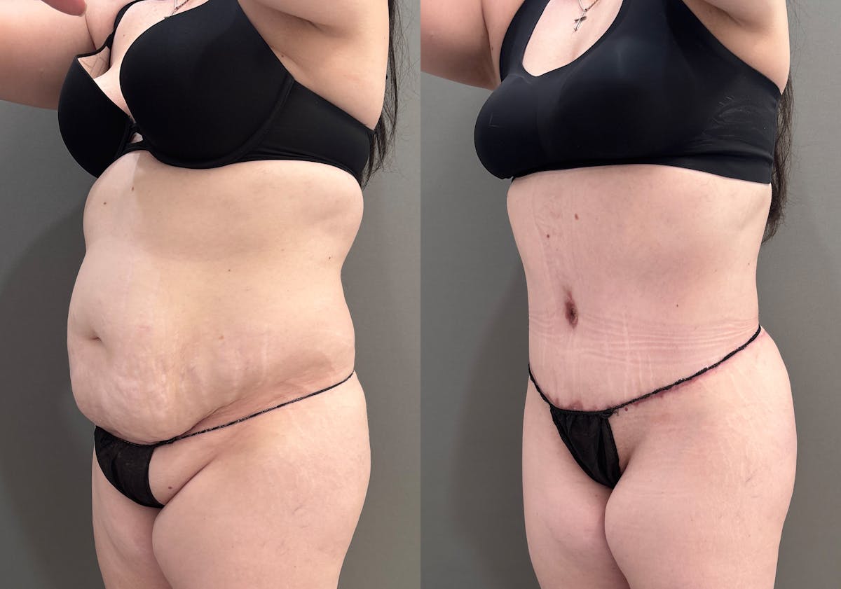 Liposuction Before & After Gallery - Patient 197100 - Image 6