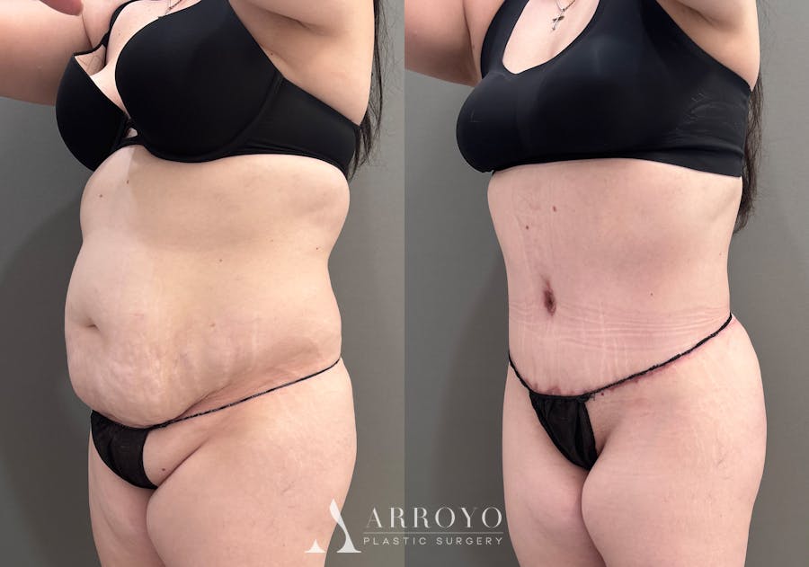 Tummy Tuck Before & After Gallery - Patient 340366 - Image 6