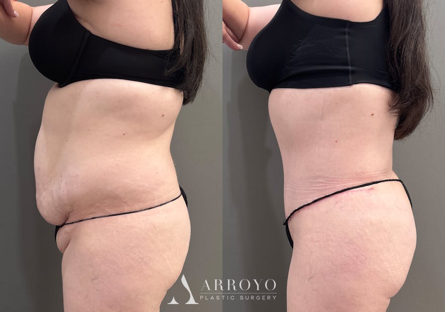 Tummy Tuck Before & After Gallery - Patient 340366 - Image 7