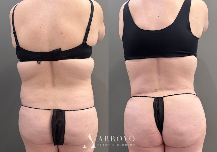 Tummy Tuck Before & After Gallery - Patient 340366 - Image 5