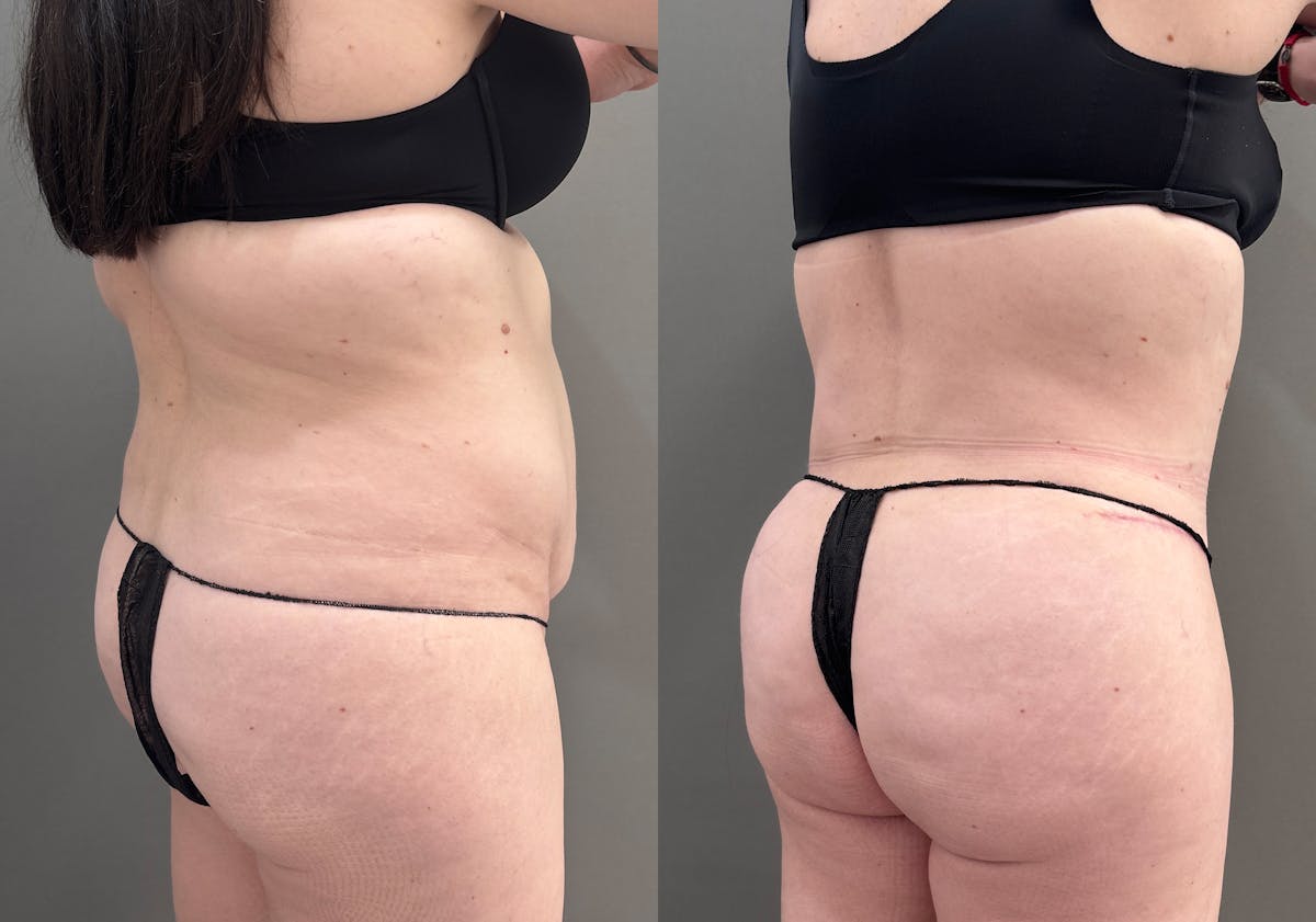 Liposuction Before & After Gallery - Patient 197100 - Image 4