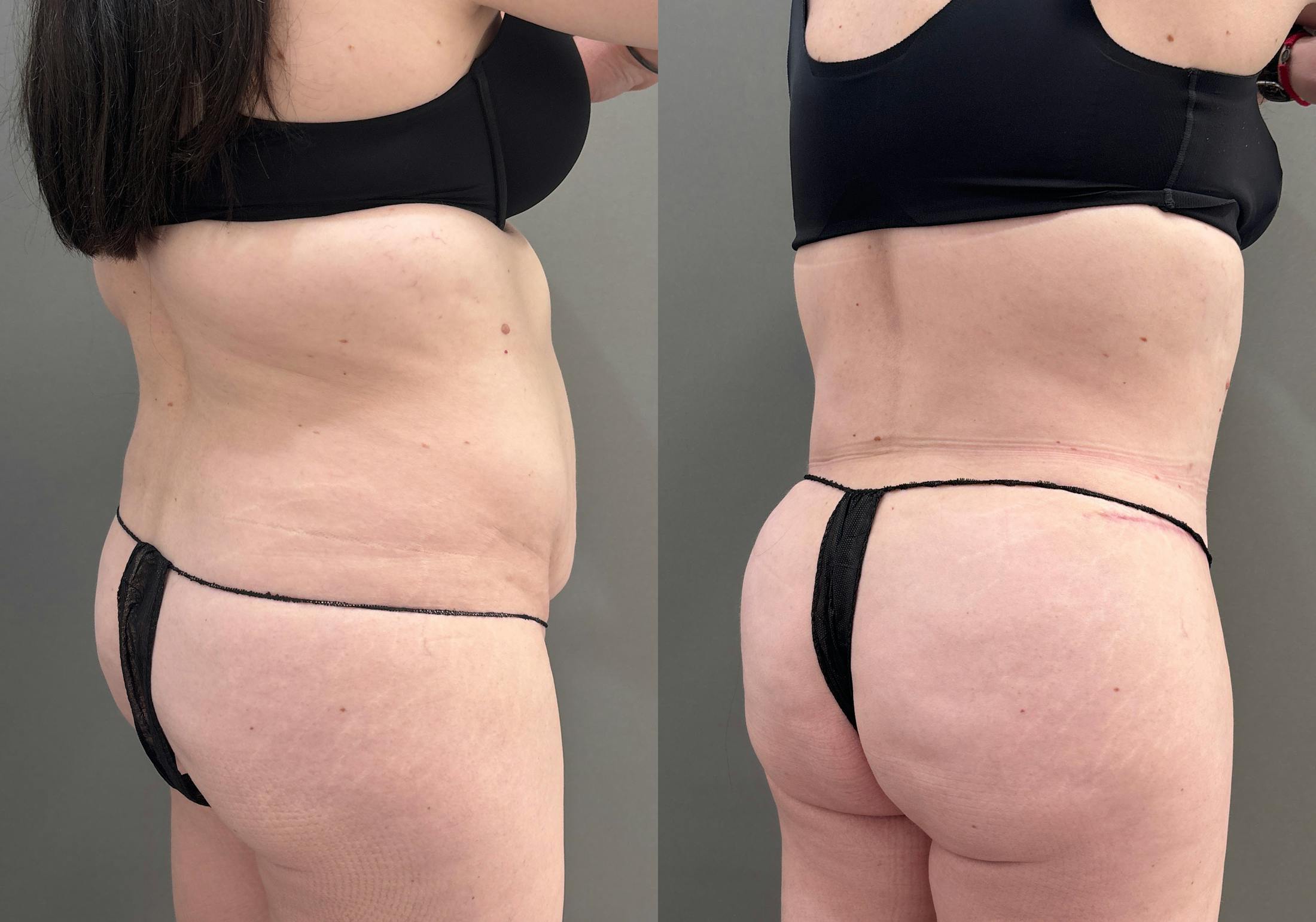 Tummy Tuck Before & After Gallery - Patient 340366 - Image 4