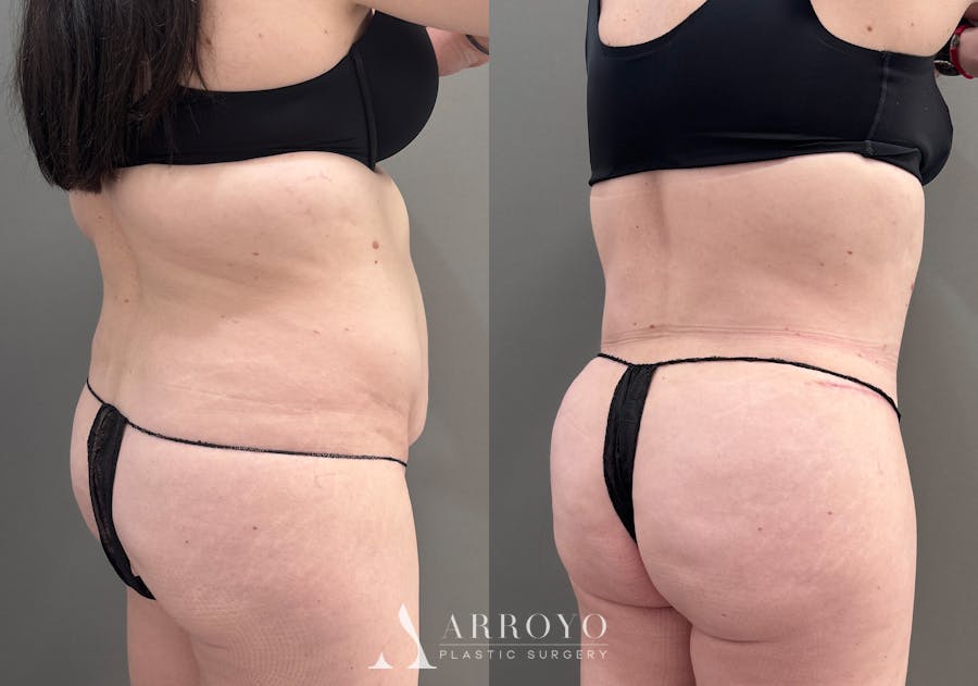 Tummy Tuck Before & After Gallery - Patient 340366 - Image 4