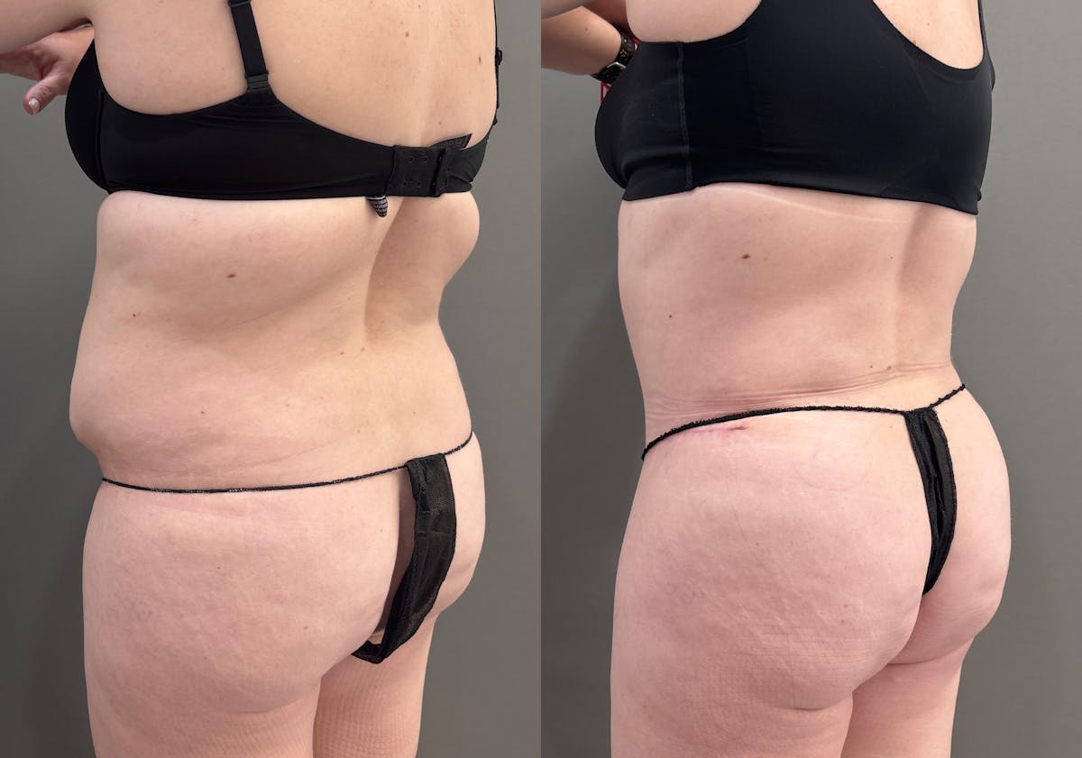 Liposuction Before & After Gallery - Patient 197100 - Image 8