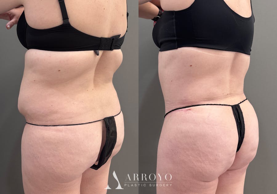Tummy Tuck Before & After Gallery - Patient 340366 - Image 8