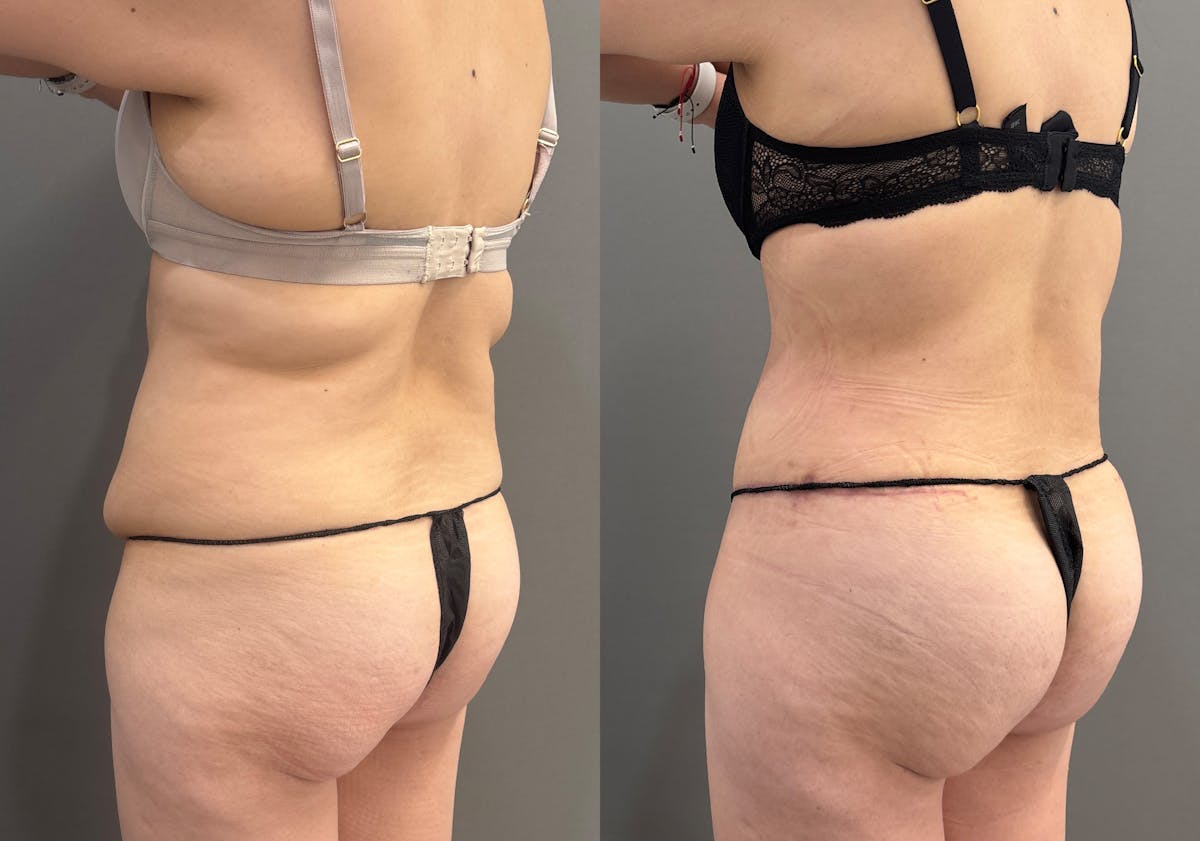 Tummy Tuck Before & After Gallery - Patient 366013 - Image 8