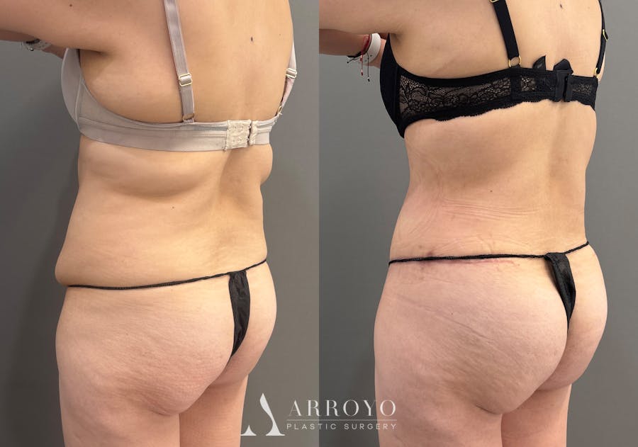 Tummy Tuck Before & After Gallery - Patient 366013 - Image 8