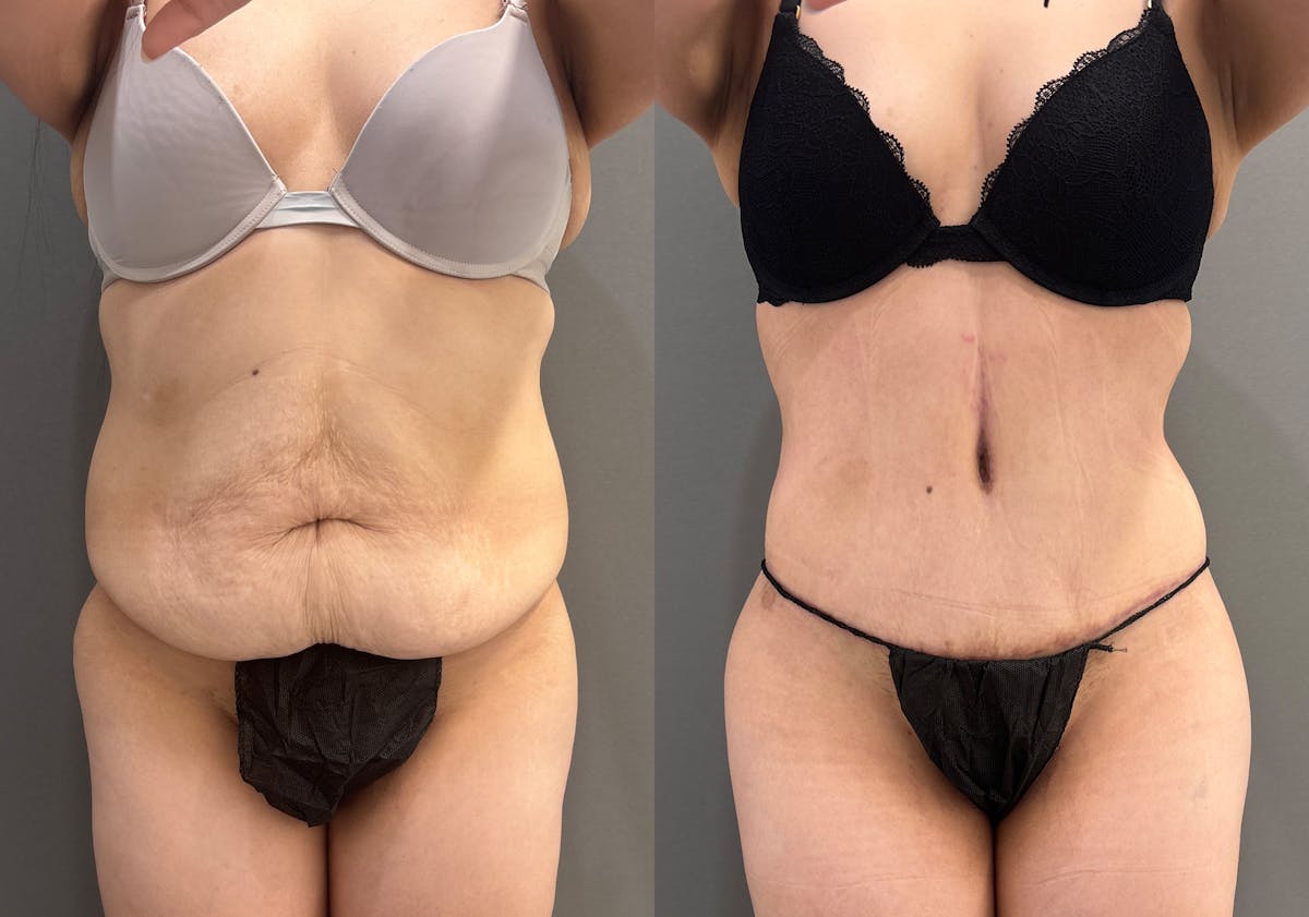 Tummy Tuck Before & After Gallery - Patient 366013 - Image 1