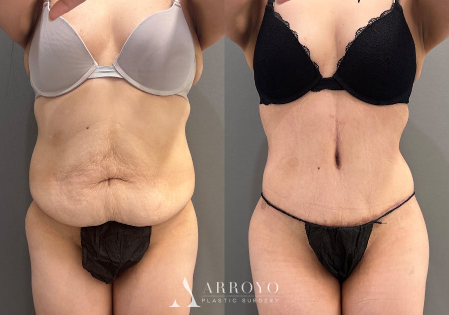 Tummy Tuck Before & After Gallery - Patient 366013 - Image 1