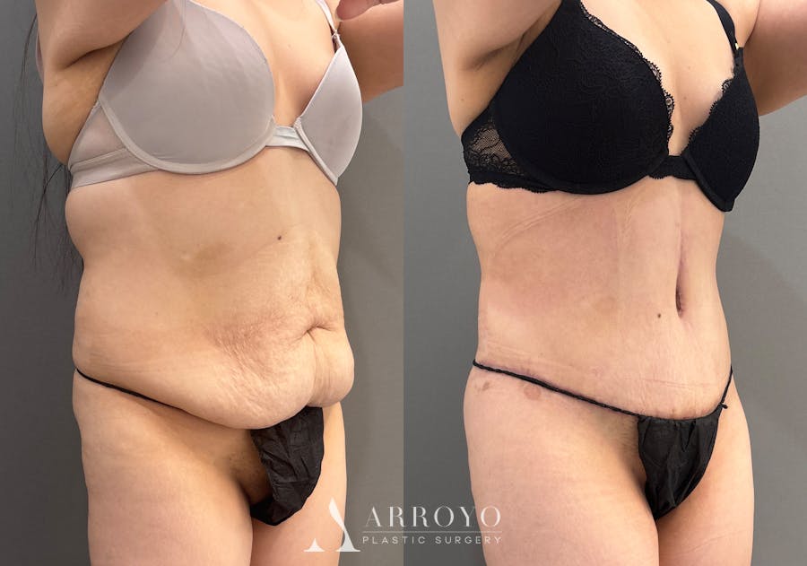 Tummy Tuck Before & After Gallery - Patient 366013 - Image 2