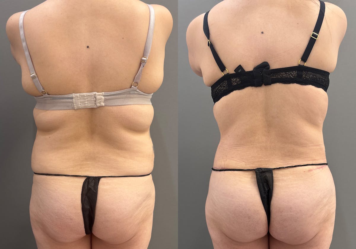 Tummy Tuck Before & After Gallery - Patient 366013 - Image 5