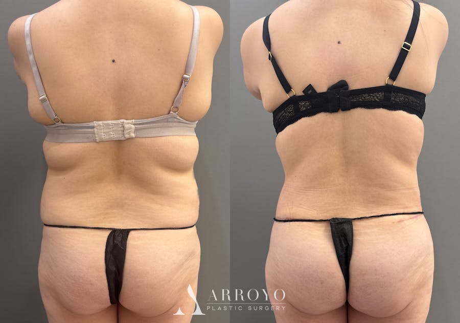 Tummy Tuck Before & After Gallery - Patient 366013 - Image 5