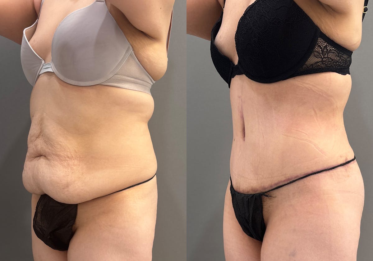Tummy Tuck Before & After Gallery - Patient 366013 - Image 6
