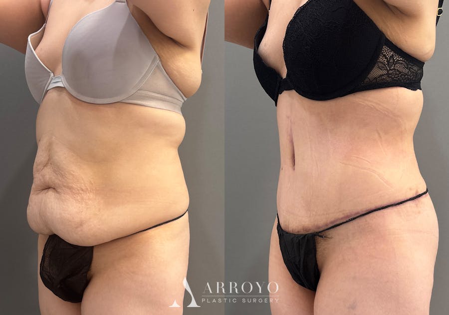 Tummy Tuck Before & After Gallery - Patient 366013 - Image 6