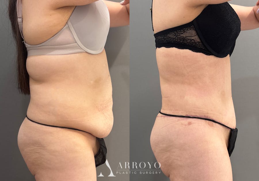 Tummy Tuck Before & After Gallery - Patient 366013 - Image 3