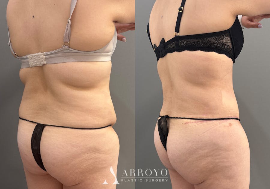 Tummy Tuck Before & After Gallery - Patient 366013 - Image 4