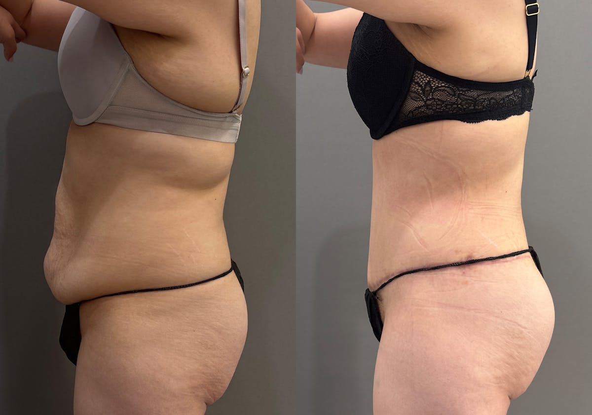 Tummy Tuck Before & After Gallery - Patient 366013 - Image 7