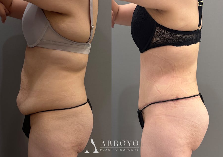 Tummy Tuck Before & After Gallery - Patient 366013 - Image 7