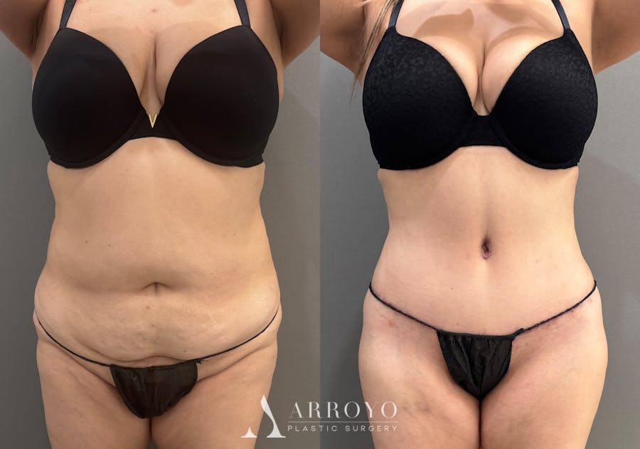 Tummy Tuck Before & After Gallery - Patient 319675 - Image 1