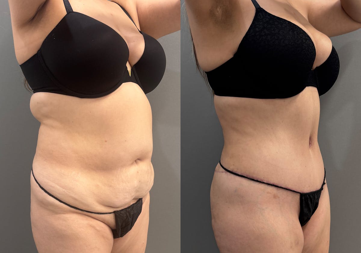 Tummy Tuck Before & After Gallery - Patient 319675 - Image 2