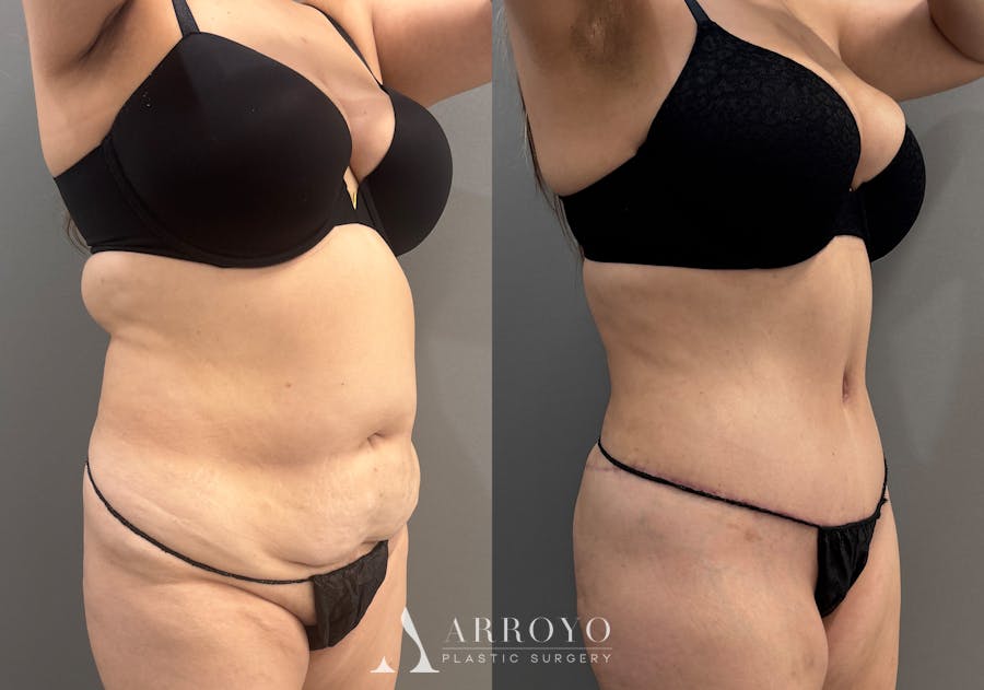 Tummy Tuck Before & After Gallery - Patient 319675 - Image 2