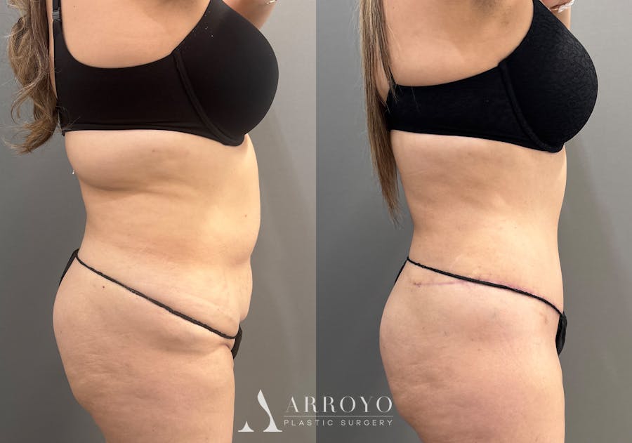 Tummy Tuck Before & After Gallery - Patient 319675 - Image 3