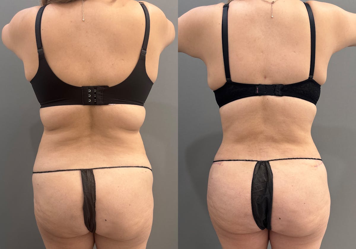 Tummy Tuck Before & After Gallery - Patient 319675 - Image 5