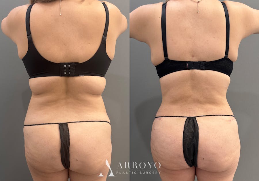 Tummy Tuck Before & After Gallery - Patient 319675 - Image 5
