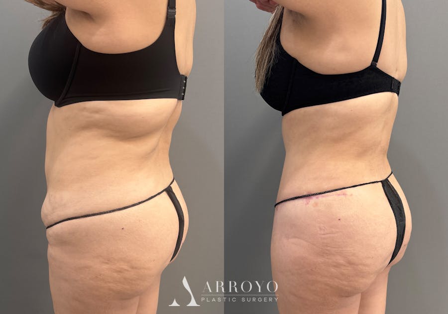 Tummy Tuck Before & After Gallery - Patient 319675 - Image 7