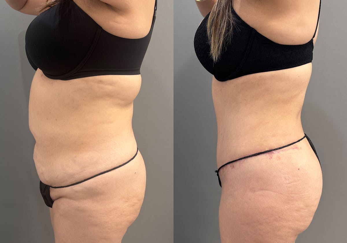Tummy Tuck Before & After Gallery - Patient 319675 - Image 6