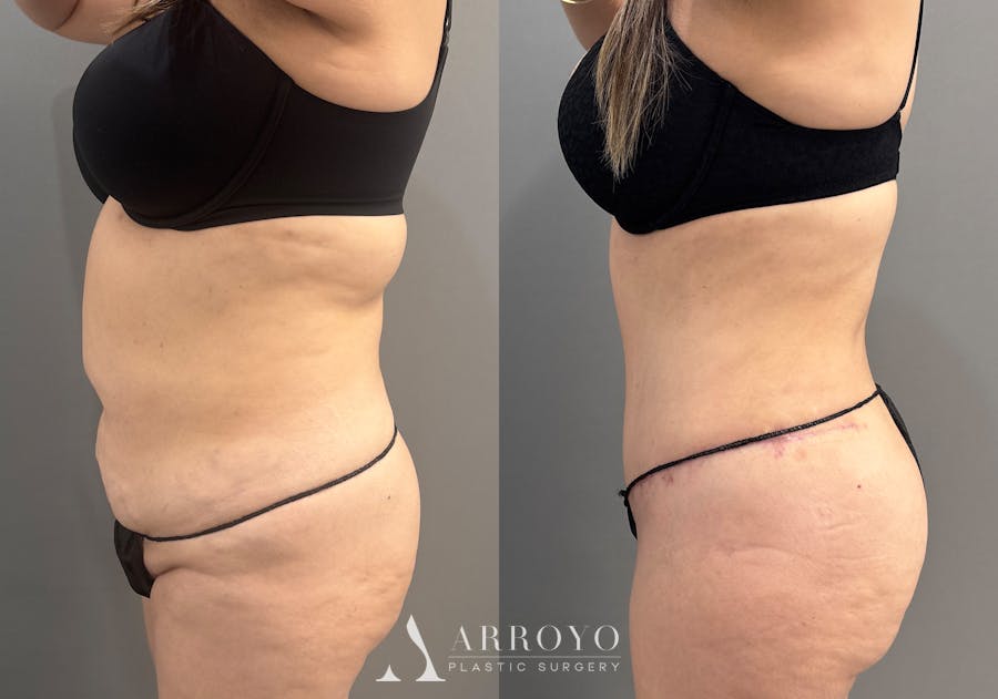 Tummy Tuck Before & After Gallery - Patient 319675 - Image 6