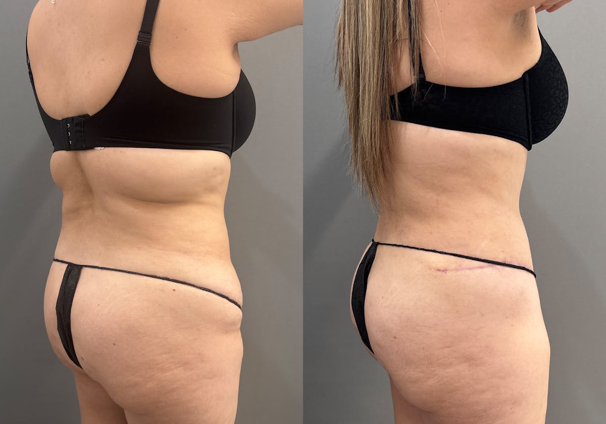 Tummy Tuck Before & After Gallery - Patient 319675 - Image 4