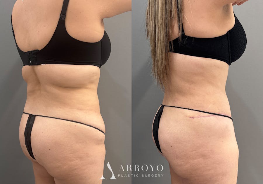 Tummy Tuck Before & After Gallery - Patient 319675 - Image 4