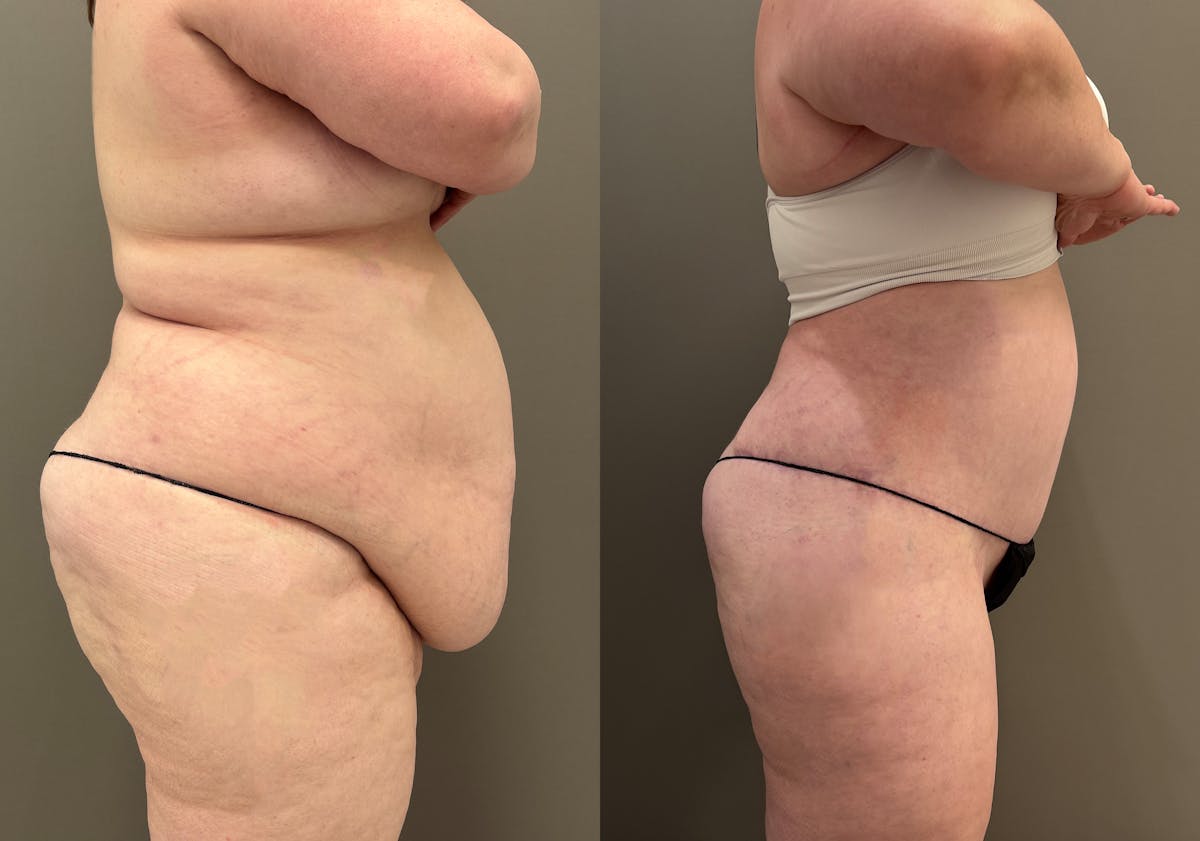 Thigh Lift Before & After Gallery - Patient 340741 - Image 3