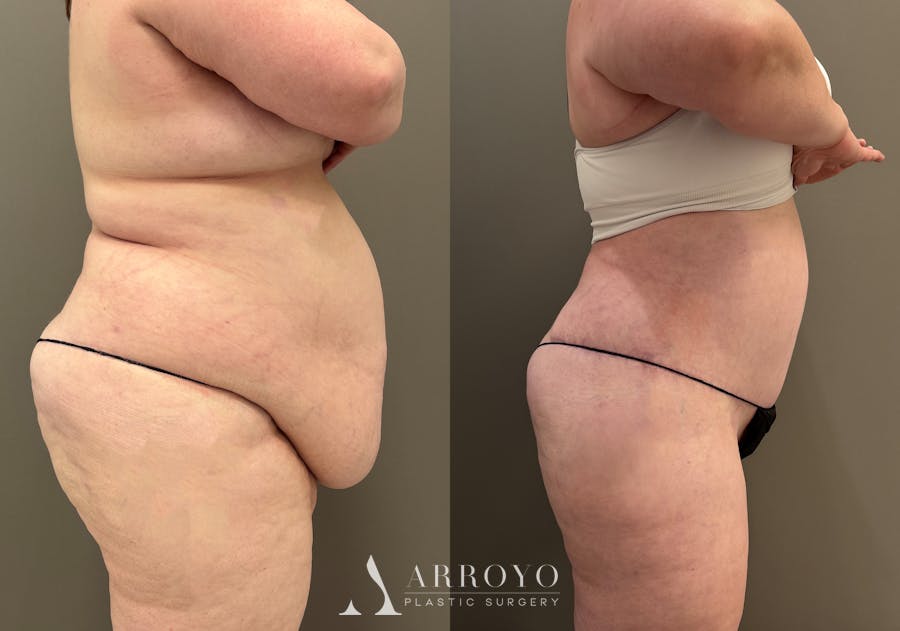 Tummy Tuck Before & After Gallery - Patient 165622 - Image 3