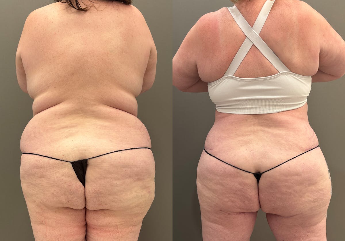 Thigh Lift Before & After Gallery - Patient 340741 - Image 4