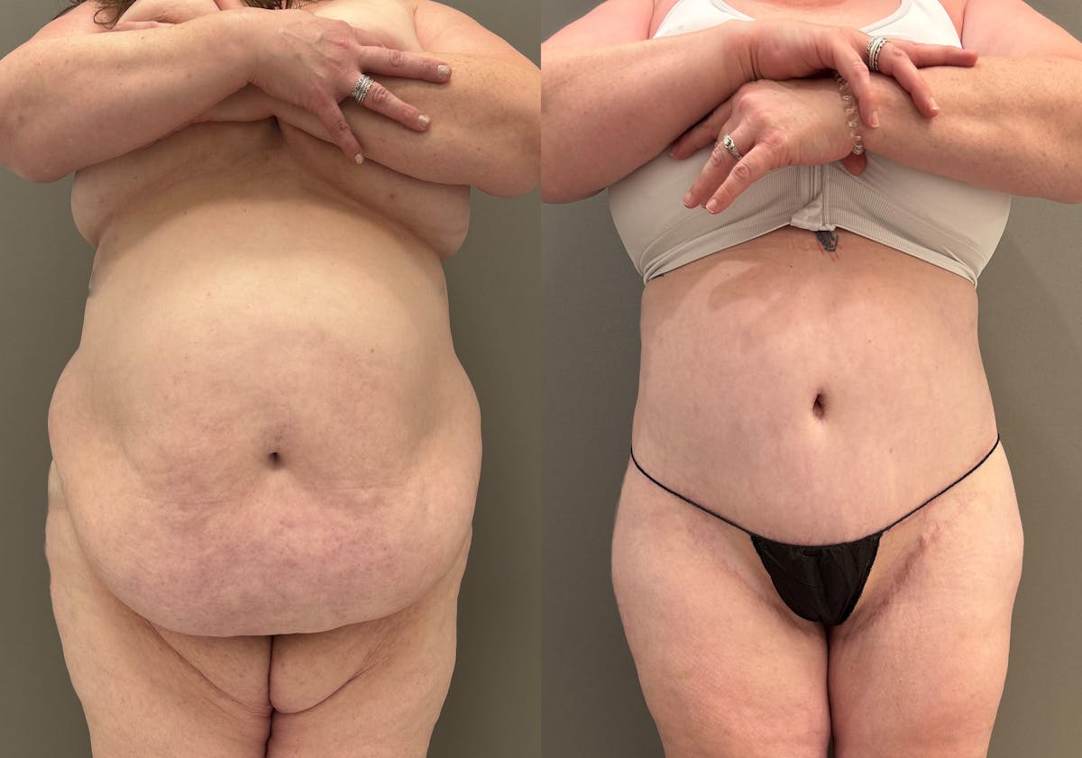 Thigh Lift Before & After Gallery - Patient 340741 - Image 1
