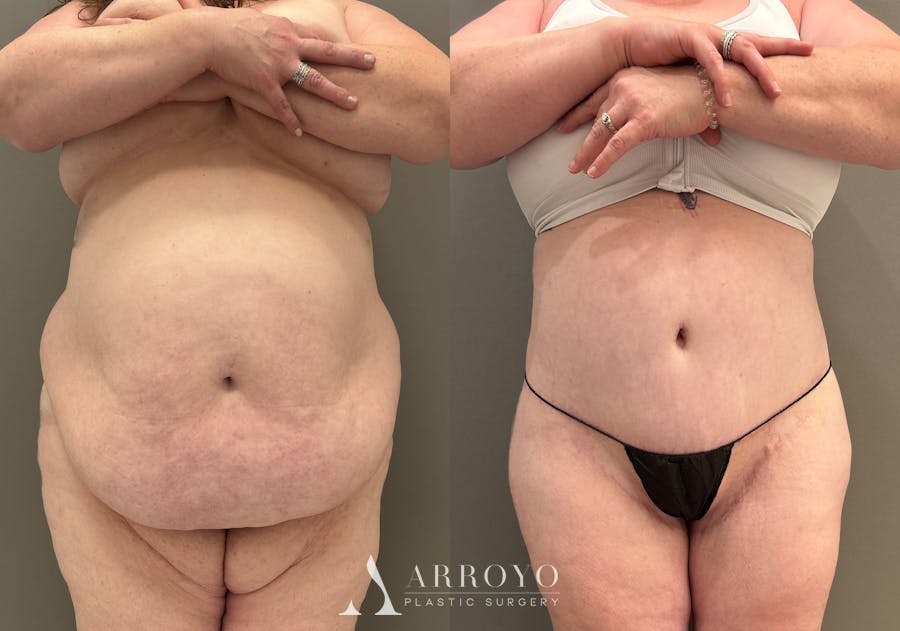 Tummy Tuck Before & After Gallery - Patient 165622 - Image 1
