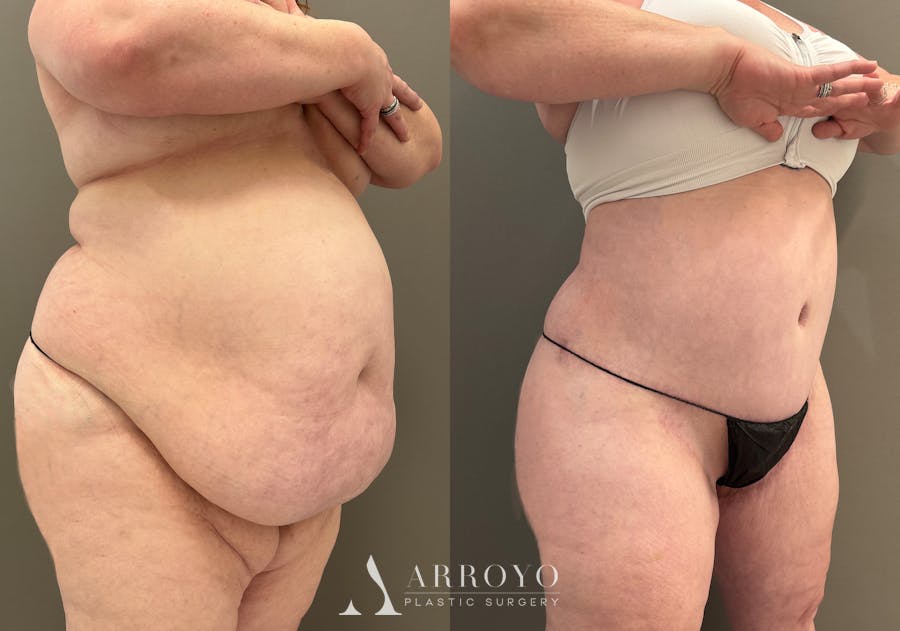 Tummy Tuck Before & After Gallery - Patient 165622 - Image 2