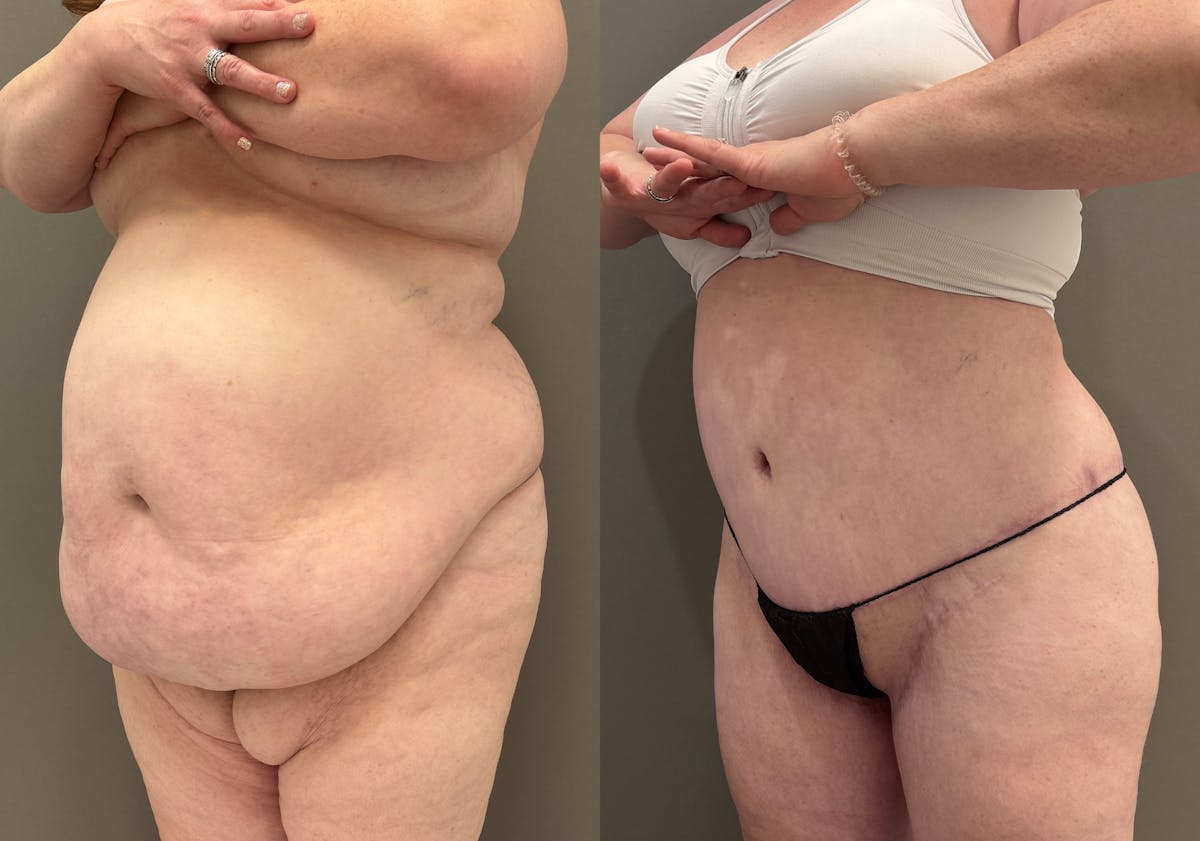 Thigh Lift Before & After Gallery - Patient 340741 - Image 5