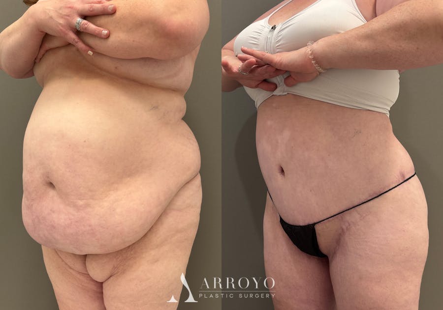 Tummy Tuck Before & After Gallery - Patient 165622 - Image 5