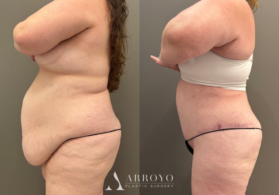 Tummy Tuck Before & After Gallery - Patient 165622 - Image 6