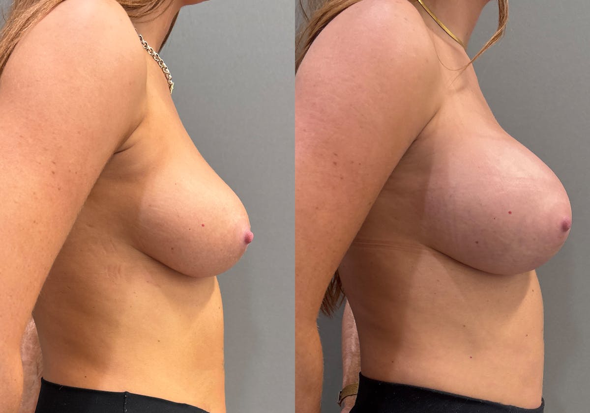 Breast Augmentation Before & After Gallery - Patient 271412 - Image 3